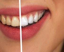 Comment avoir des dents blanches ?