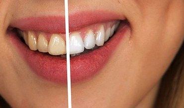 Comment avoir des dents blanches ?