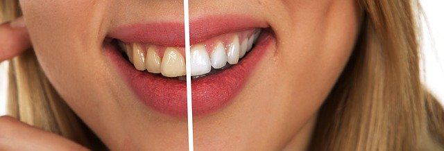 Comment avoir des dents blanches ?
